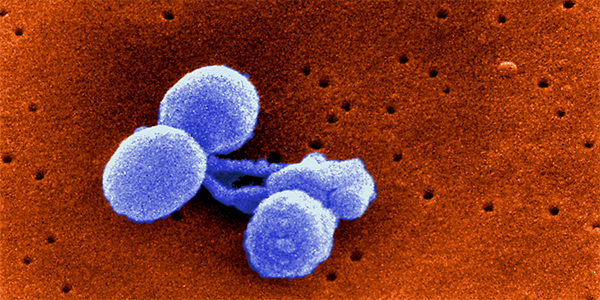 Estimating the Burden of Pneumonia Hospitalizations