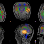 New Test Has Potential to Guide Treatment for 30% of Meningioma Patients