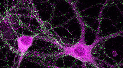 magenta brain cells displaying anomalies